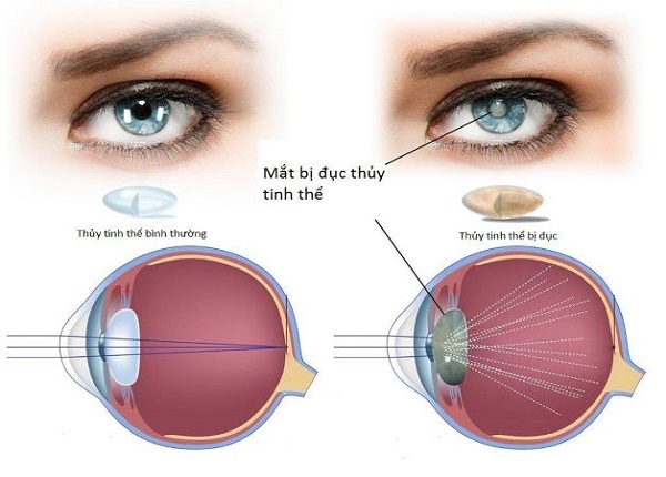 Ánh sáng xanh có thể gây đục thủy tinh thể