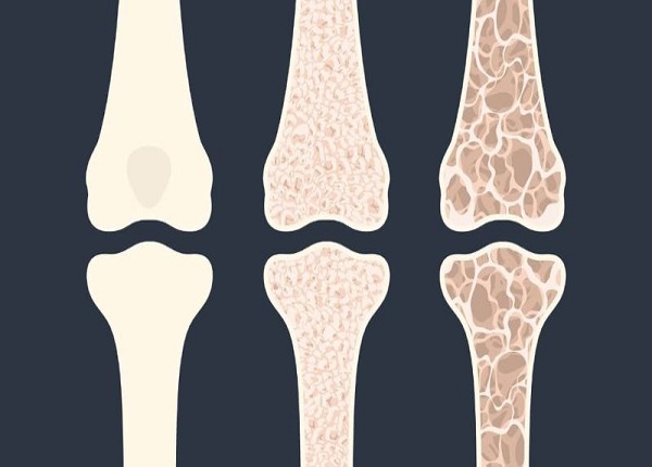 Người mắc bệnh xương thủy tinh thường dễ gãy xương ngay cả sau va chạm nhỏ