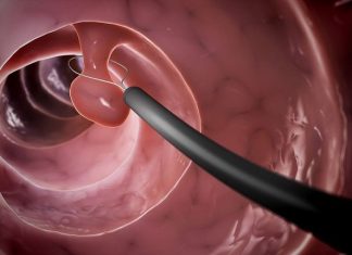 Cắt polyp đại tràng là thủ thuật thường được thực hiện trong nội soi nhằm loại bỏ các khối u nhỏ trong lòng đại tràng