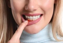 Chảy máu chân răng có thể là dấu hiệu của thiếu vitamin