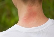 Bị côn trùng đốt là tình huống thường gặp trong sinh hoạt hàng ngày
