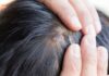 Điều trị da đầu nổi mụn có thể sẽ khó khăn hơn các vùng khác