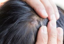 Điều trị da đầu nổi mụn có thể sẽ khó khăn hơn các vùng khác