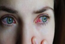Đau mắt đỏ là vấn đề phổ biến