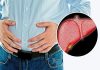 Gan nhiễm mỡ là căn bệnh phổ biến