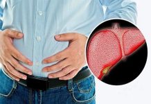 Gan nhiễm mỡ là căn bệnh phổ biến