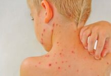 Bệnh lupus ban đỏ có thể nguy hiểm đến tính mạng nếu không được phát hiện kịp thời