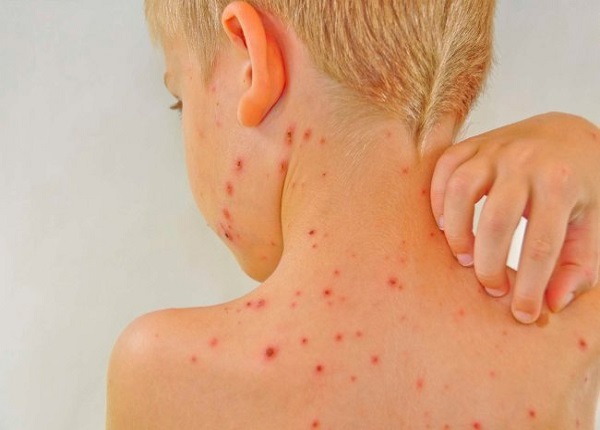 Bệnh lupus ban đỏ có thể nguy hiểm đến tính mạng nếu không được phát hiện kịp thời