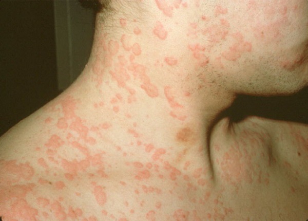 Triệu chứng bệnh mề day cholinergic thường là nổi mẩn trên da, ngứa, nóng rát và sưng ở vùng nổi mẩn