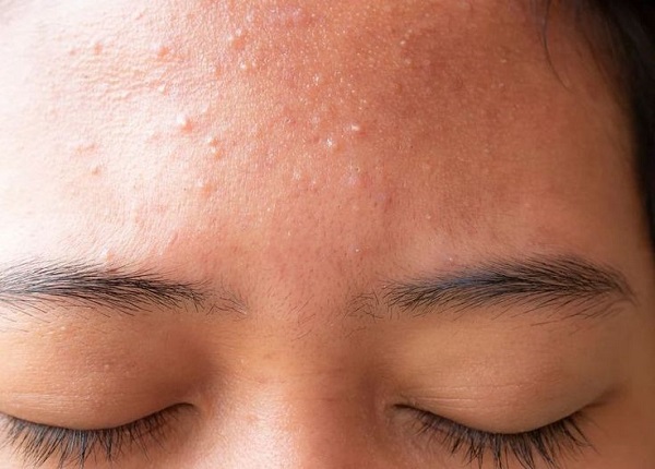 Mụn ẩn trên trán khiến da trở nên sần sùi và ảnh hưởng đến thẩm mỹ
