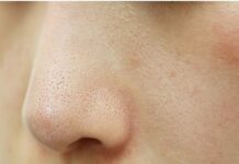 Mụn cám ở mũi có thể gây cảm giác tự ti về ngoại hình