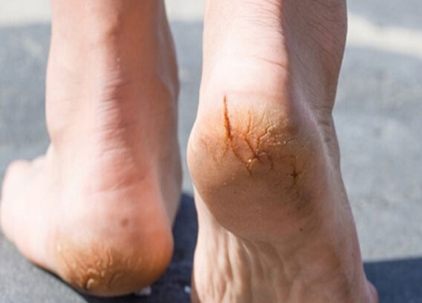 Nứt gót chân có thể ảnh hưởng đến đời sống hàng ngày của người bị