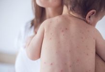 Tình trạng trẻ phát ban sau sốt khiến nhiều bậc cha mẹ bối rối