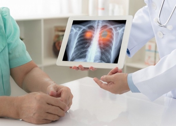 U nang phổi có ảnh hưởng nhiều đến sức khỏe không?