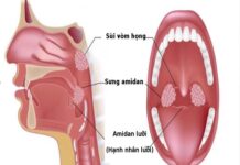 Viêm amidan là gì?