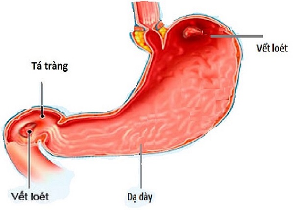 Viêm dạ dày tá tràng là một căn bệnh phổ biến